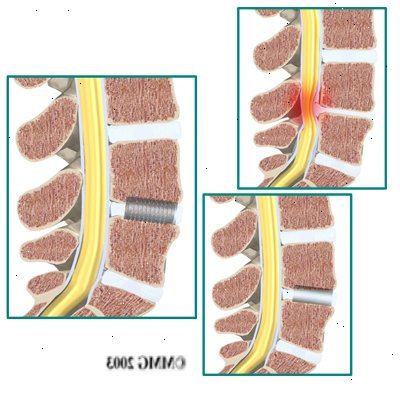 Spinal svakhet eller ustabilitet. Kroniske korsryggsmerter. Spinal svakhet eller ustabilitet. Kroniske korsryggsmerter.