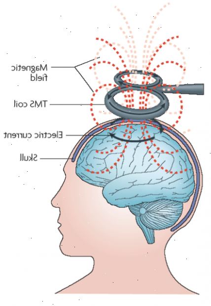 Transkranial magnetisk stimulering. Du har noe metall eller implanterte medisinske enheter. Transkranial magnetisk stimulering. Du har noe metall eller implanterte medisinske enheter.