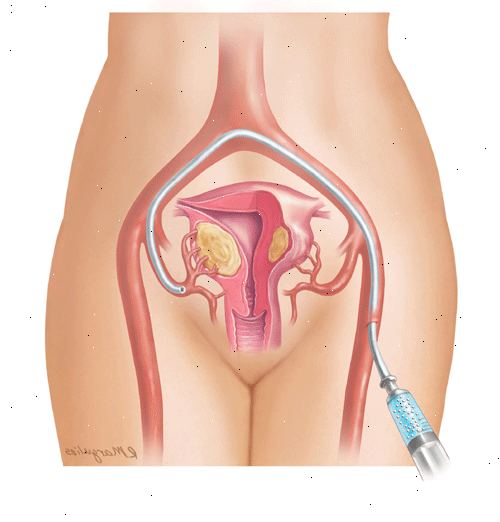 Livmor arterie embolisering. Skade på andre organer. Livmor arterie embolisering. Skade på andre organer.