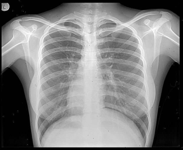 X-ray. Brudd og infeksjoner. X-ray. Brudd og infeksjoner.
