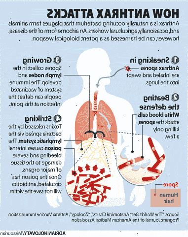Anthrax. Gastrointestinal miltbrann. Anthrax. Gastrointestinal miltbrann.