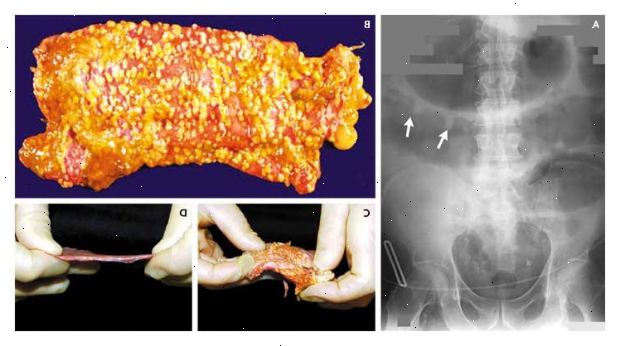 Pseudomembranøs kolitt. Unormalt lave nivåer av kalium. Pseudomembranøs kolitt. Unormalt lave nivåer av kalium.
