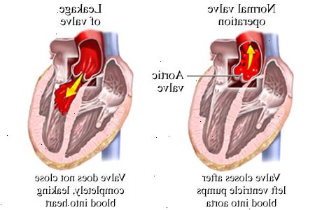Aortaklaffen oppgulp. En medfødt hjertefeil. Aortaklaffen oppgulp. En medfødt hjertefeil.