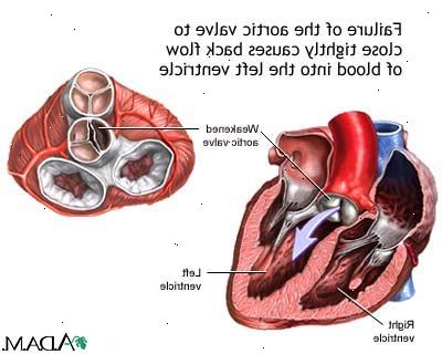 Forberedelser til din avtale. Forringelse av ventilen med alderen. Forberedelser til din avtale. Forringelse av ventilen med alderen.