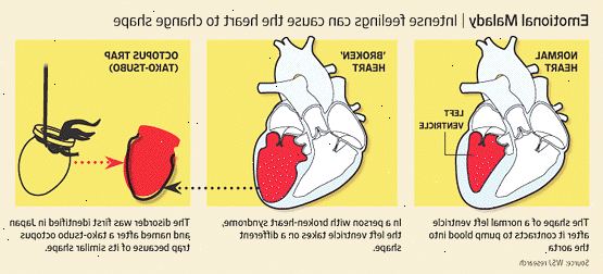 Broken heart syndrome. Hvordan er brutt hjerte syndrom forskjellig fra et hjerteinfarkt? Broken heart syndrome. Hvordan er brutt hjerte syndrom forskjellig fra et hjerteinfarkt?