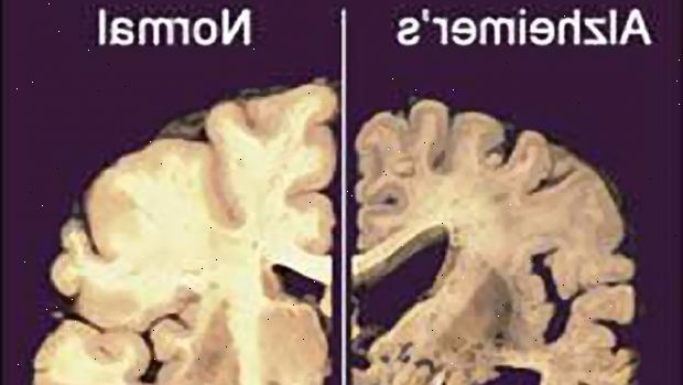 Alzheimers sykdom. Arbeid i to forskjellige hjernen kjemiske meldingssystemer. Alzheimers sykdom. Arbeid i to forskjellige hjernen kjemiske meldingssystemer.