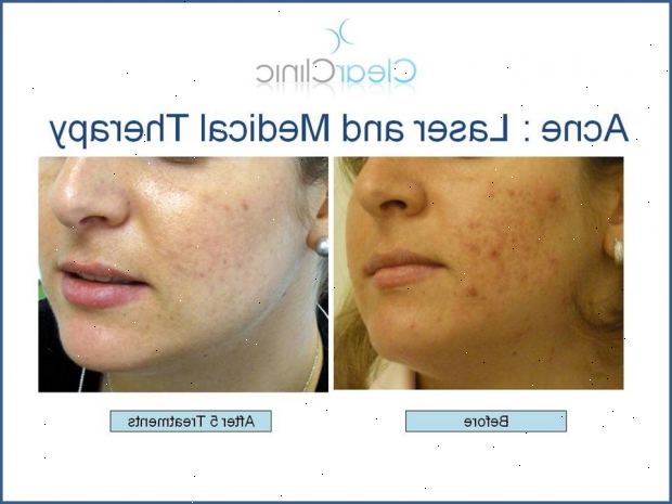 Acne. Acne behandlinger: medisinske prosedyrer kan bidra klar hud. Acne. Acne behandlinger: medisinske prosedyrer kan bidra klar hud.