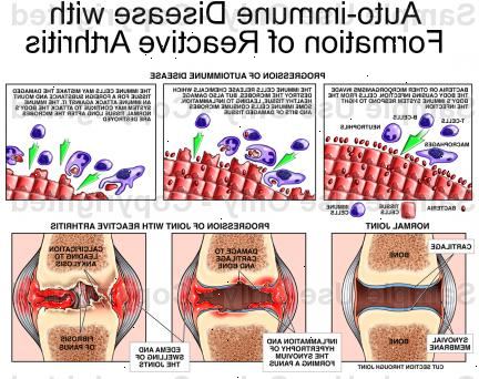 Forberedelser til din avtale. Ikke-steroide antiinflammatoriske legemidler (NSAIDs). Forberedelser til din avtale. Ikke-steroide antiinflammatoriske legemidler (NSAIDs).