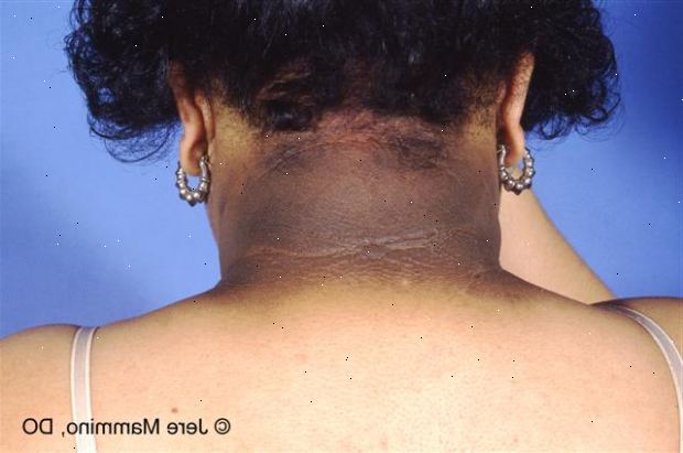 Acanthosis nigricans. Forberedelser til din avtale. Acanthosis nigricans. Forberedelser til din avtale.