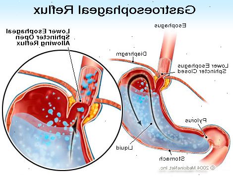 GERD. Innsnevring av spiserøret (esophageal striktur). GERD. Innsnevring av spiserøret (esophageal striktur).