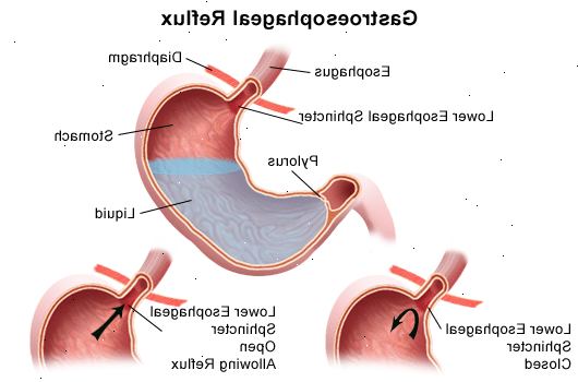 Forberedelser til din avtale. Et åpent sår i spiserøret (esophageal sår). Forberedelser til din avtale. Et åpent sår i spiserøret (esophageal sår).