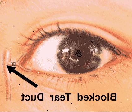 Blokkert rive duct. Øyeinfeksjoner eller betennelse. Blokkert rive duct. Øyeinfeksjoner eller betennelse.