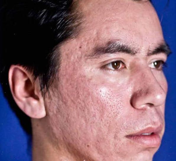 Acne. Noninflammatory lesjoner. Acne. Noninflammatory lesjoner.