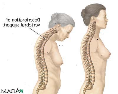 Osteoporose. Gastrointestinal kirurgi. Osteoporose. Gastrointestinal kirurgi.