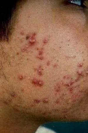 Forberedelser til din avtale. Komedoner (whiteheads og hudormer). Forberedelser til din avtale. Komedoner (whiteheads og hudormer).