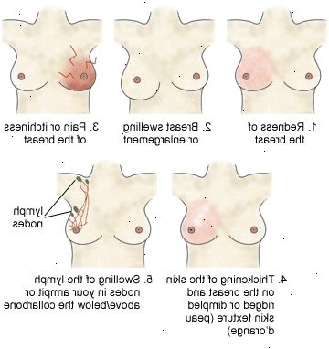 Inflammatorisk brystkreft. Vær oppmerksom på eventuelle pre-avtale begrensninger. Inflammatorisk brystkreft. Vær oppmerksom på eventuelle pre-avtale begrensninger.