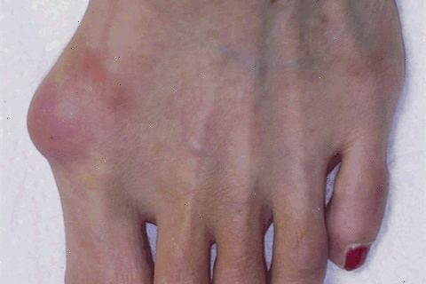 Bunions. Hva du kan forvente fra legen din. Bunions. Hva du kan forvente fra legen din.