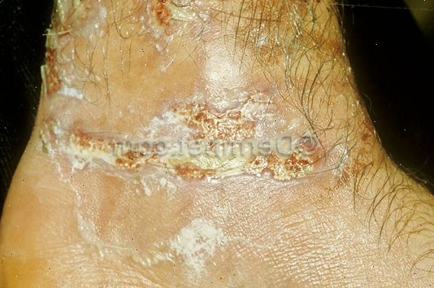 Forberedelser til din avtale. Farlig lav kroppstemperatur (hypotermi). Forberedelser til din avtale. Farlig lav kroppstemperatur (hypotermi).
