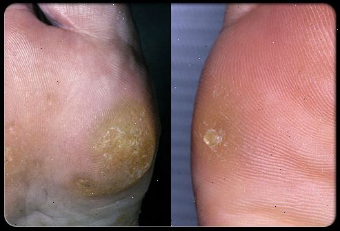 Liktorn og hard hud. Bunions, hammertoe eller andre foten misdannelser. Liktorn og hard hud. Bunions, hammertoe eller andre foten misdannelser.