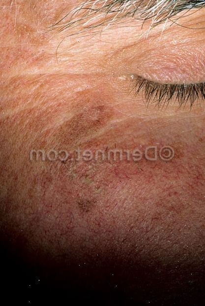 Aktinisk keratose. Hva du kan forvente fra legen din. Aktinisk keratose. Hva du kan forvente fra legen din.