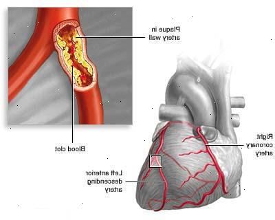 Akutt koronarsyndrom. Elektrokardiogram (ECG). Akutt koronarsyndrom. Elektrokardiogram (ECG).