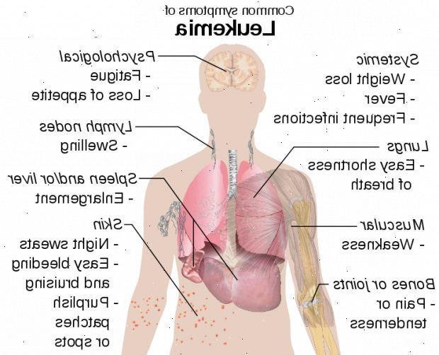 Forberedelser til din avtale. Lymfatisk leukemi. Forberedelser til din avtale. Lymfatisk leukemi.