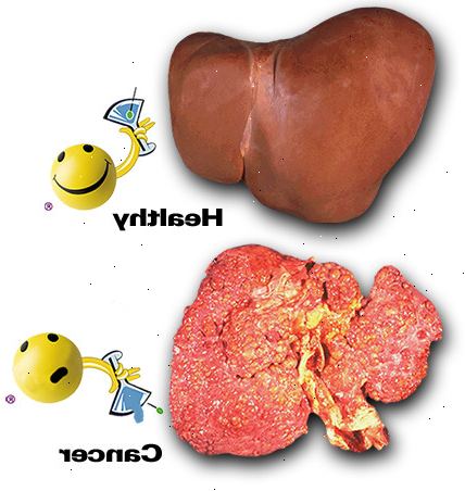 Leverkreft. Kronisk infeksjon med HBV eller HCV. Leverkreft. Kronisk infeksjon med HBV eller HCV.