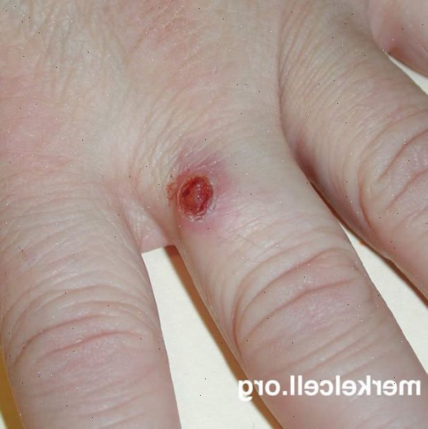 Merkel cell carcinoma. Overdreven eksponering for naturlig eller kunstig sollys. Merkel cell carcinoma. Overdreven eksponering for naturlig eller kunstig sollys.