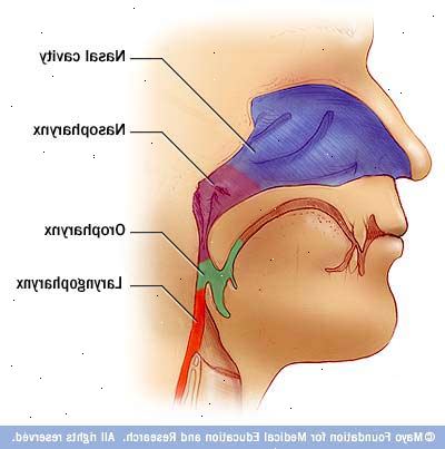 Nasofaryngeal carcinoma. Kreft som vokser til å invadere nærliggende strukturer. Nasofaryngeal carcinoma. Kreft som vokser til å invadere nærliggende strukturer.