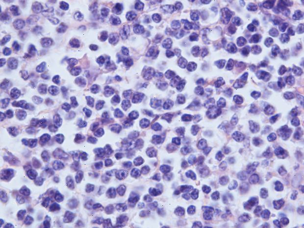 Non-Hodgkins lymfom. Hvor non-Hodgkins lymfom oppstår. Non-Hodgkins lymfom. Hvor non-Hodgkins lymfom oppstår.