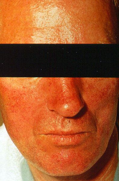 Karsinoid syndrom. Pustevansker. Karsinoid syndrom. Pustevansker.