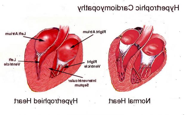 Kardiomyopati. Dilatert kardiomyopati. Kardiomyopati. Dilatert kardiomyopati.