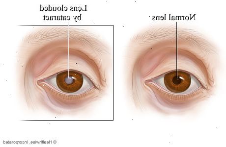 Forberedelser til din avtale. Grå stær som påvirker kantene på linsen (cortical katarakt). Forberedelser til din avtale. Grå stær som påvirker kantene på linsen (cortical katarakt).
