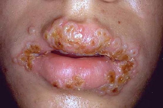 Klamydia. Andre seksuelt overførbare infeksjoner. Klamydia. Andre seksuelt overførbare infeksjoner.