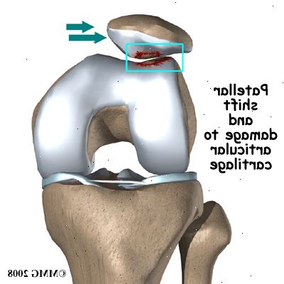 Chondromalacia patella. Dårlig kontroll av musklene dine. Chondromalacia patella. Dårlig kontroll av musklene dine.
