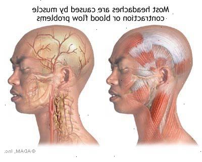 Cluster hodepine. Datastyrte tomografi (CT) scan. Cluster hodepine. Datastyrte tomografi (CT) scan.