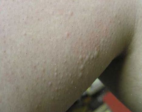 Cold urticaria. Du er et barn eller ung voksen. Cold urticaria. Du er et barn eller ung voksen.