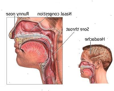 Forkjølelse. Akutt ørebetennelse (otitis media). Forkjølelse. Akutt ørebetennelse (otitis media).