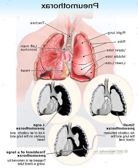 Pneumothorax. Underliggende lungesykdommer. Pneumothorax. Underliggende lungesykdommer.