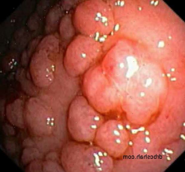 Forberedelser til din avtale. Inflammatorisk tarm. Forberedelser til din avtale. Inflammatorisk tarm.