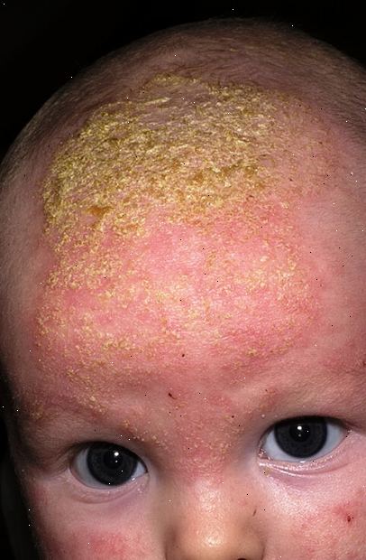 Cradle cap. Forberedelser til din avtale. Cradle cap. Forberedelser til din avtale.