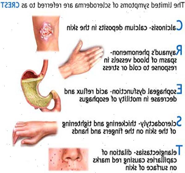 Begrenset sklerodermi (CREST syndrom). Tight, herdet hud. Begrenset sklerodermi (CREST syndrom). Tight, herdet hud.