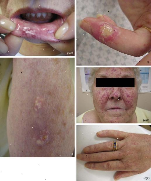 Forberedelser til din avtale. Raynauds fenomen. Forberedelser til din avtale. Raynauds fenomen.