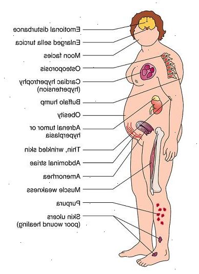 Cushing syndrom. Vanlige tegn og symptomer. Cushing syndrom. Vanlige tegn og symptomer.
