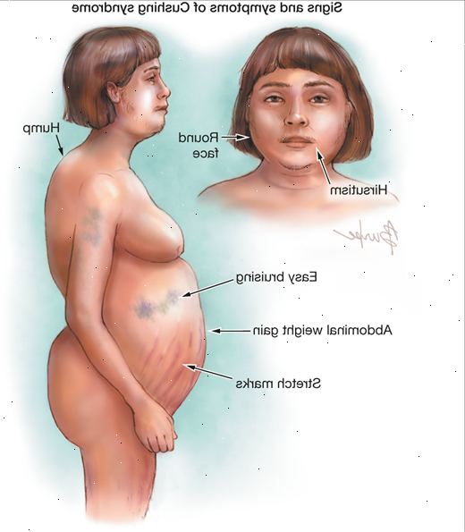 Forberedelser til din avtale. Kvinner med Cushing syndrom. Forberedelser til din avtale. Kvinner med Cushing syndrom.