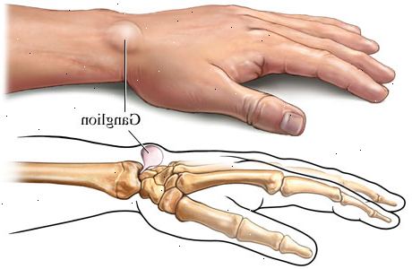 Ganglion cyster. Ledd eller sene skade. Ganglion cyster. Ledd eller sene skade.