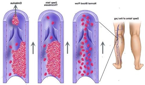 Dyp venetrombose (DVT). Advarselen tegn på en lungeemboli inkludere. Dyp venetrombose (DVT). Advarselen tegn på en lungeemboli inkludere.
