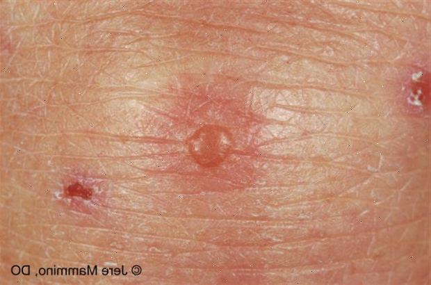 Dermatitt. Atopisk dermatitt (eksem). Dermatitt. Atopisk dermatitt (eksem).