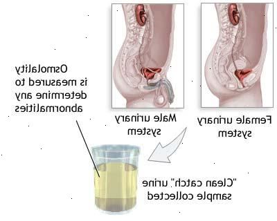 Diabetes insipidus. Sentrale diabetes insipidus. Diabetes insipidus. Sentrale diabetes insipidus.