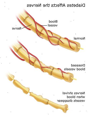 Diabetisk nevropati. Perifer nevropati. Diabetisk nevropati. Perifer nevropati.